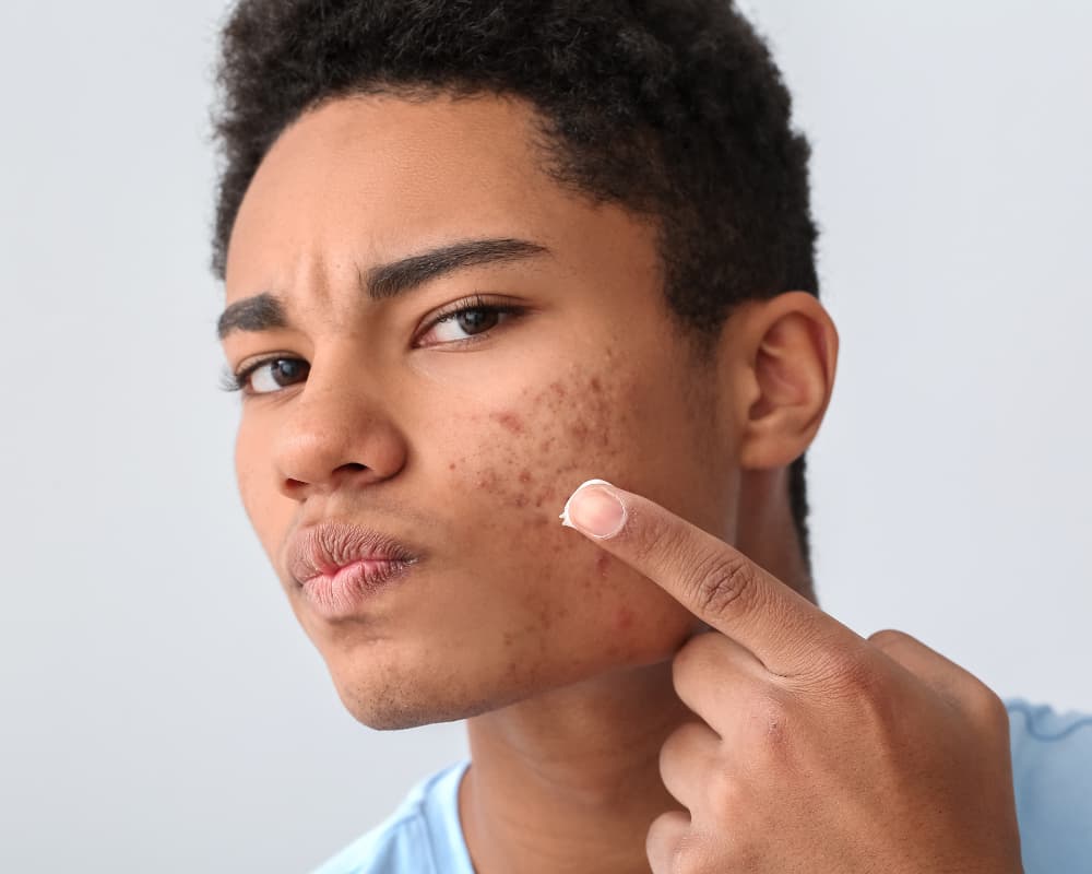 Peau acnéique